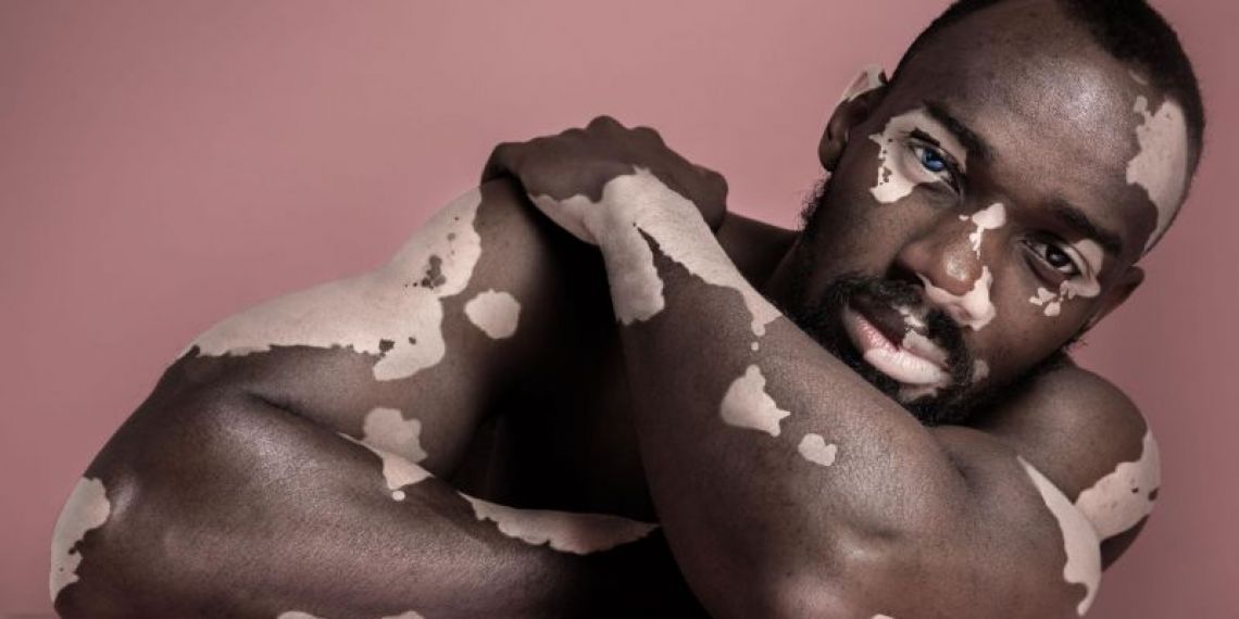 Vous êtes atteint de vitiligo ? Bonne nouvelle, un nouveau traitement intégralement remboursé par l’Assurance maladie est désormais disponible !